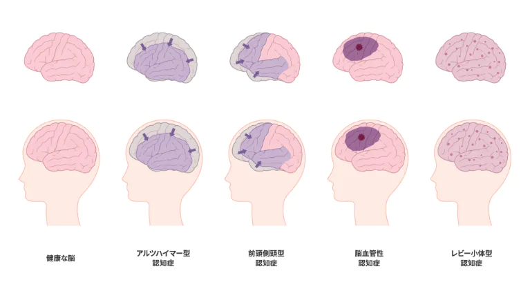 認知症の種類